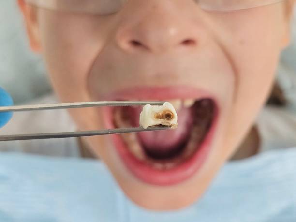 Best Knocked-Out Tooth (Avulsed Tooth) Treatment in South Hooksett, NH